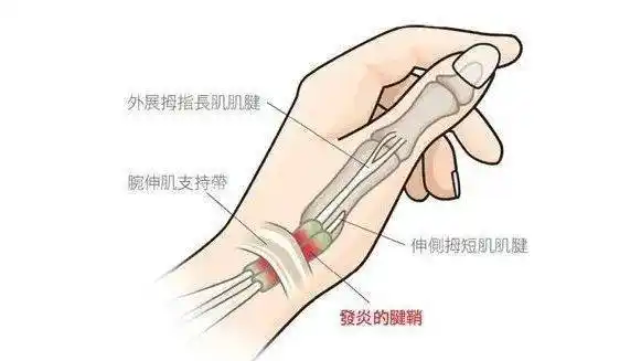 tenosynovitis / de quervains tenosynovitis),它是指手腕近大拇指