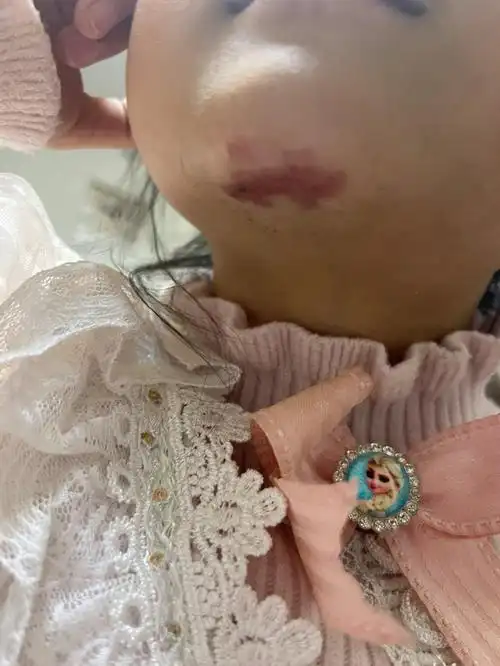 点阵激光后第三天