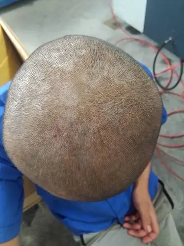 女生的头癣初期图片_有来医生