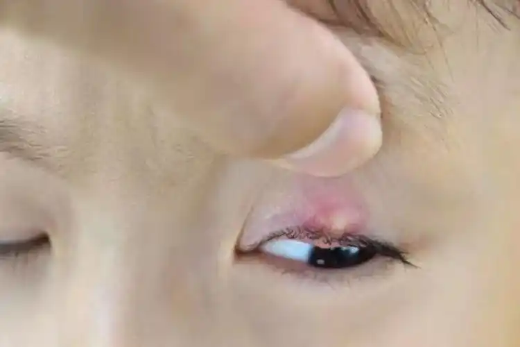 孩子长了"针眼",应根据不同情况选择治疗方式