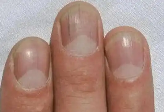 指甲出现竖纹是肝不好?提醒:指甲若出现4种症状,需留心观察