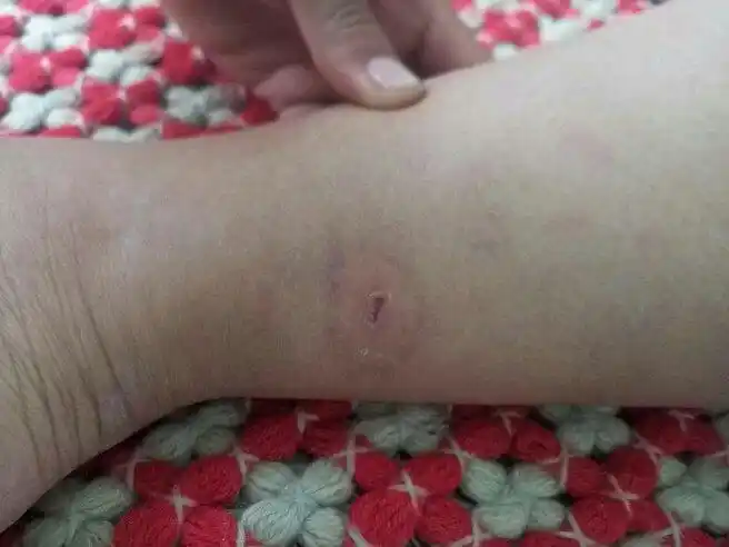 前两天被一只刚生下小狗几天的狗咬了,刚咬的时候没事,就有两个牙印