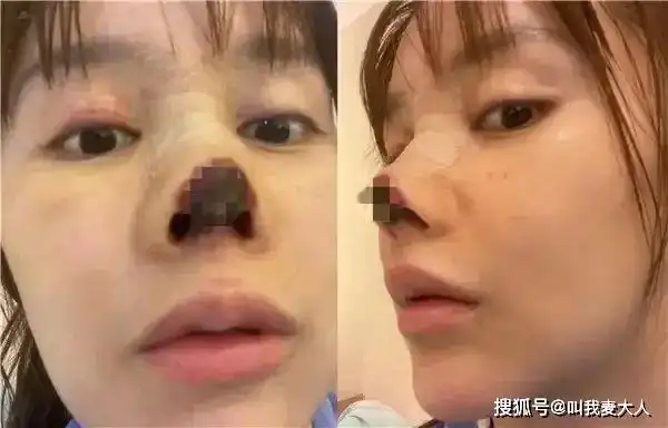 年轻女演员整容失败,鼻尖坏死,还面临200万违约金?