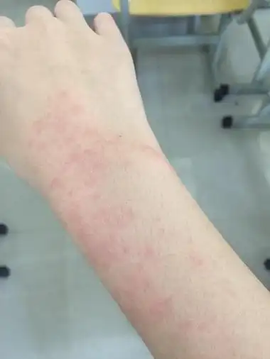 过敏性皮炎的症状-泉州广肤皮肤病医院「挂号」泉州哪家皮肤病医院好