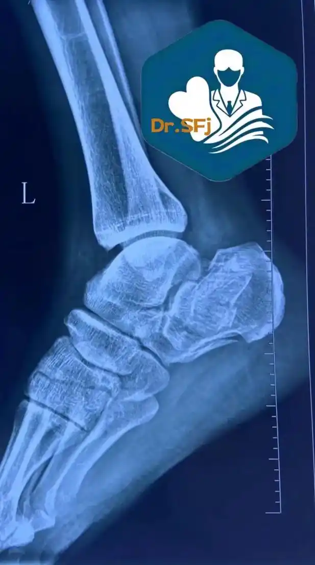 近期完成的跟骨粉碎性骨折.#骨折 #跟骨骨折 #跟骨粉碎性骨