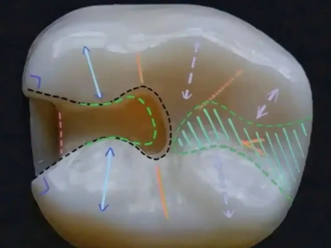 二类洞的预备标准图解.二类洞制备 调节椅位灯光 患者仰卧位, - 抖音