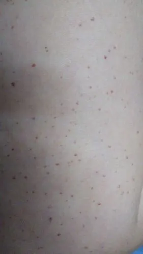 怎么搞的?手臂上的小血斑越来越多了?