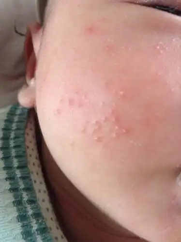 一个多月的小宝宝脸上长这种小痘痘是怎么回事?