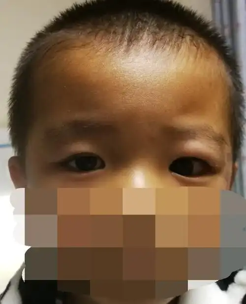 改良联合筋膜鞘悬吊(cfs)矫正低龄儿童上睑下垂效果对比 - 好大夫在线