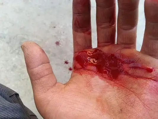 手指流血图片52