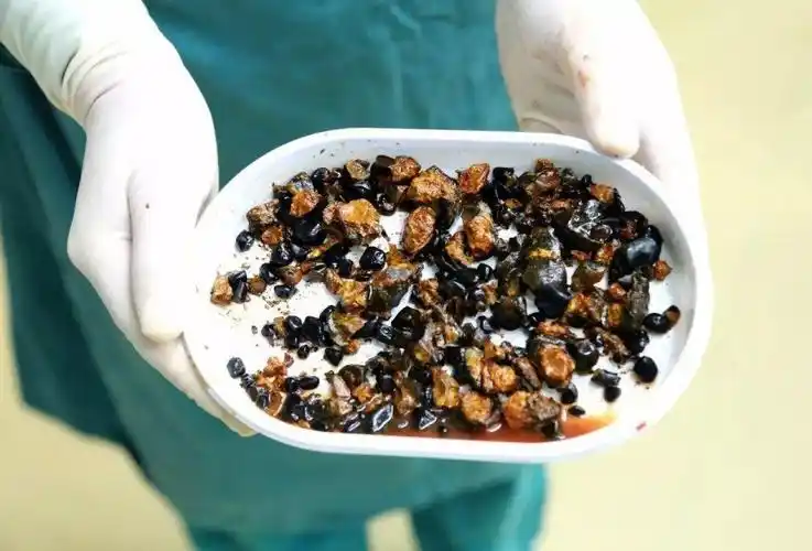 罕见!39岁女患者胆总管中取出巨量结石