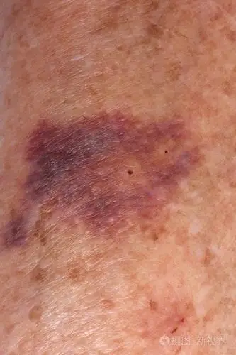 一名老年妇女手臂上的血肿