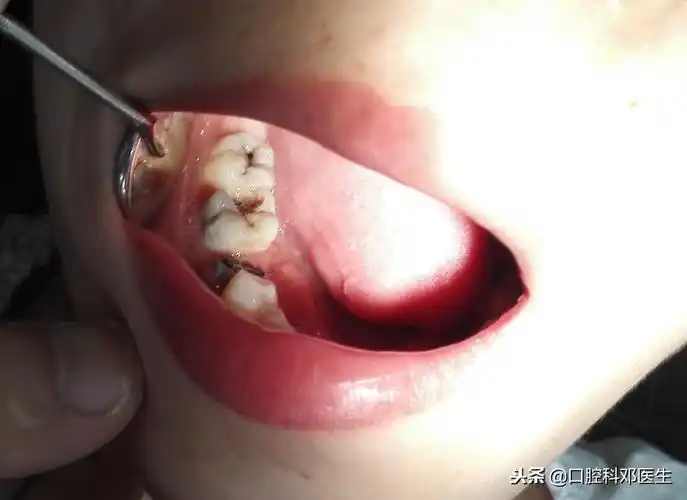 补一颗烂牙洞要多少钱小孩有蛀牙