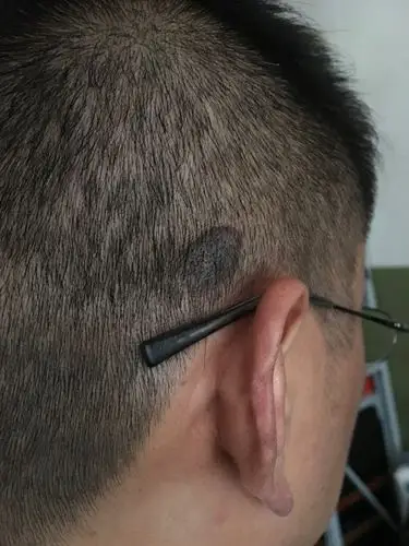 头上长了一个类似于黑痣的东西没有任何异常感觉请医生看看这