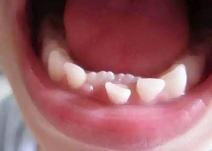 6岁娃长出双排牙,医生提醒:有这些习惯赶紧改_孩子_牙齿_乳牙