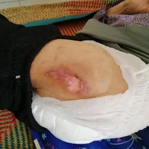 护理得当,时隔14天长者的褥疮已愈合