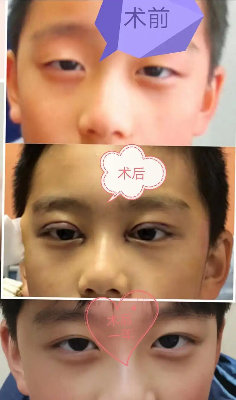 先天性睑内翻倒睫手术案例分享