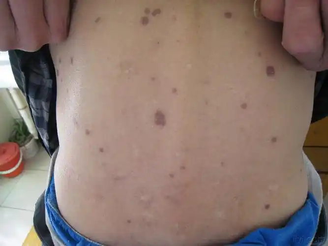 梅毒图片_梅毒症状表现图片大全_有来医生