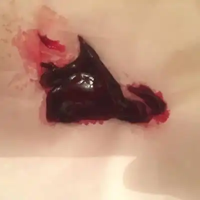 今天怀孕51天,今晚散步后下面流了好多血还有血块,小肚子疼像来月经的