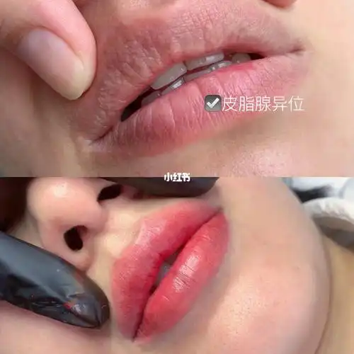 1个月前的皮脂腺异位现在怎么样了