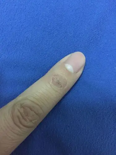 上星期看天气好洗了鞋子洗了抹布,然后手指就变这样