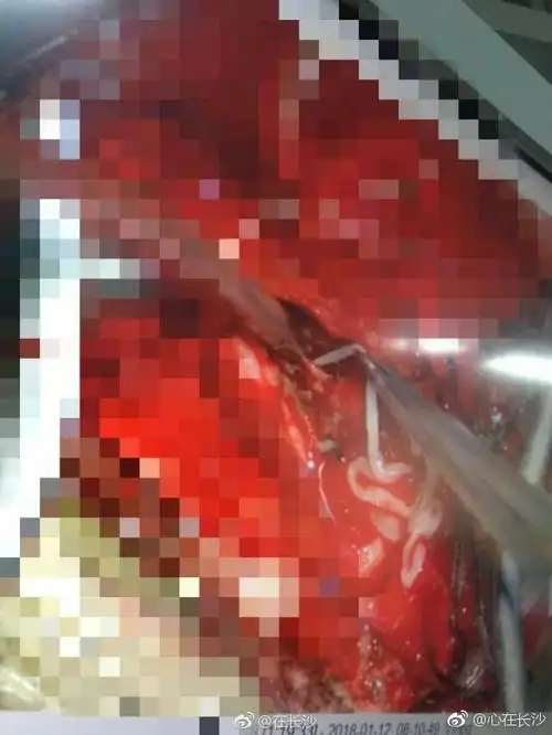 两女孩脑内长"长虫",医生开颅巧手"活捉"