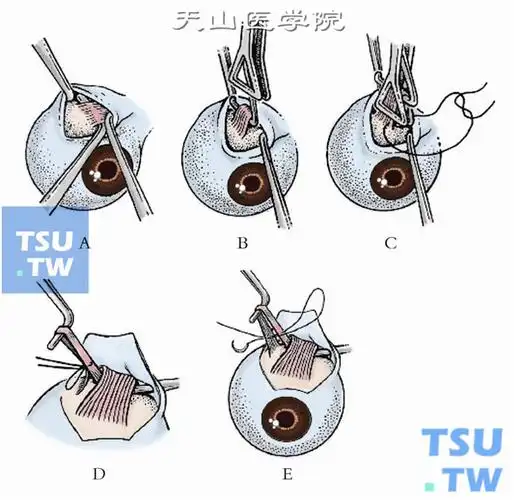 斜视手术:上斜肌折叠术操作及临床经验