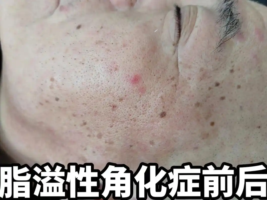 脂溢性角化症又称老年斑去除后皮肤干净好多了