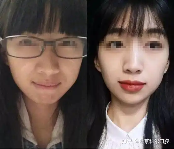 戴过牙套矫正牙齿的人脸型变了吗