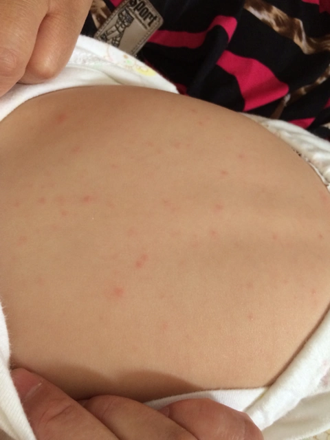 宝宝有些发烧,感冒,身上出了好多小红疙瘩