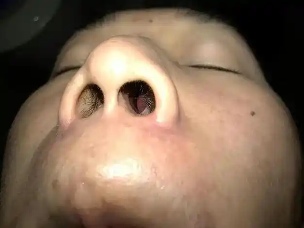 关于慢性鼻炎这三个问题你一定要知道早看早受益