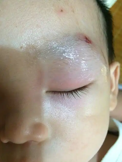 宝宝眼睛越来越肿了,什么时候才会好呀