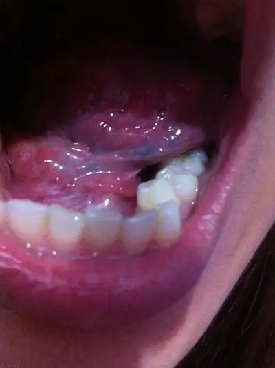 口腔癌的前兆 (50)