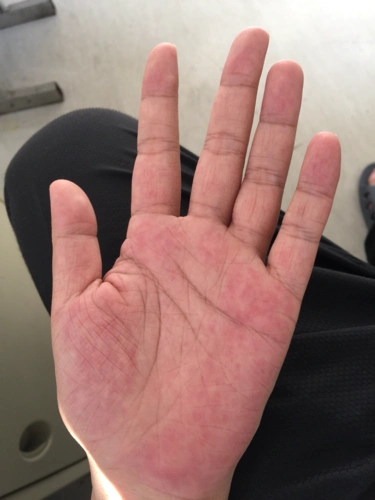 有宝妈手心发红的吗?我手心红的吓人,这是怎么了