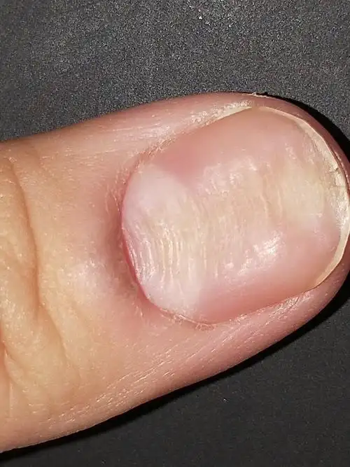 我的两个大拇指,凹凸不平,为什么?怎么办?