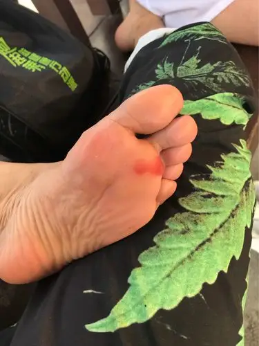 第一次脚上这样的血泡