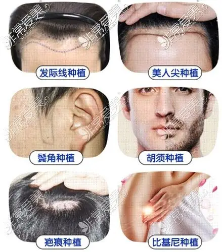 植发十个危害公布揭秘植发的危害和后遗症