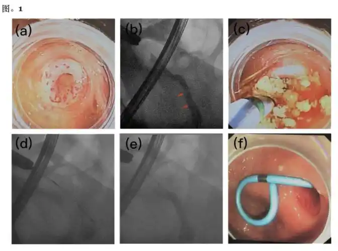 bmc02gastroenterology内镜逆行阑尾炎治疗与腹腔镜阑尾切除术与