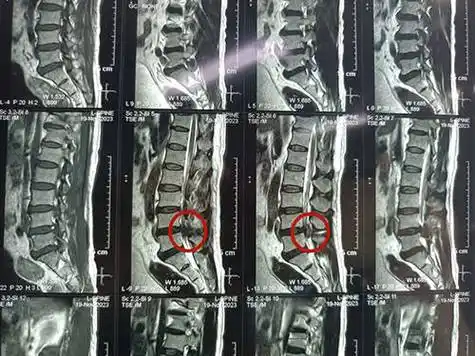 合肥中山骨科医院_男子腰痛七年,突发大小便功能障碍