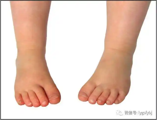 前面提过,大部份的胎儿在子宫内部都呈足内翻,小腿内旋,髋部屈曲的