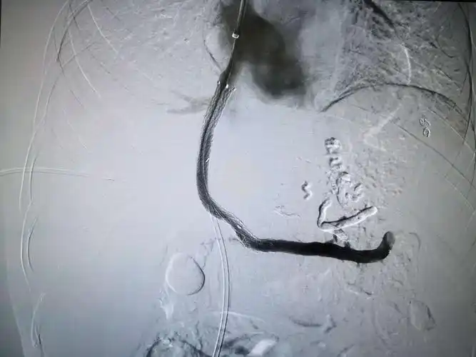 分流成功脾静脉造影