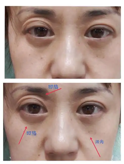 西安健丽机构去眼袋手术效果差造成严重凹陷