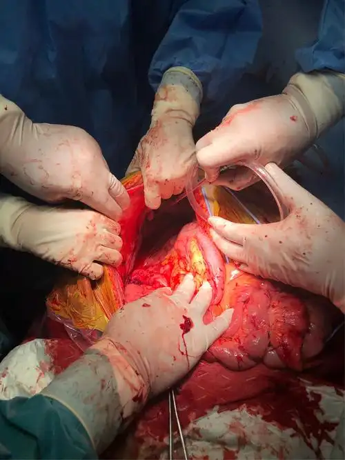 子宫肉瘤术后复发,巨大肿瘤再次手术成功