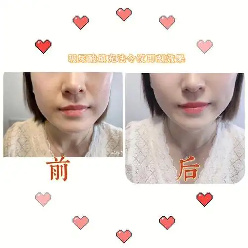 法令纹填充前后对比