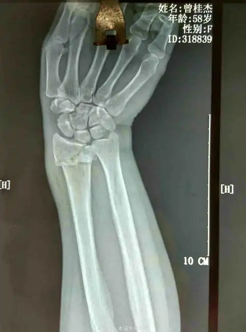 患者女58岁左colles骨折