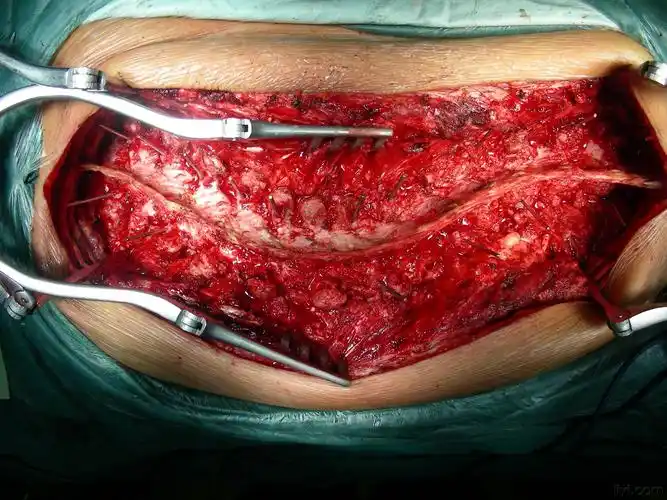 脊柱侧弯术中影像