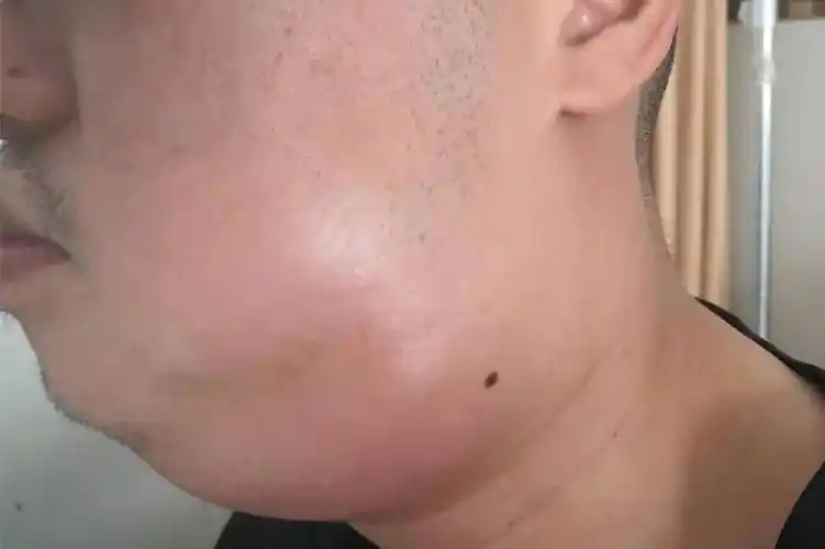 治疗前,肿瘤明显