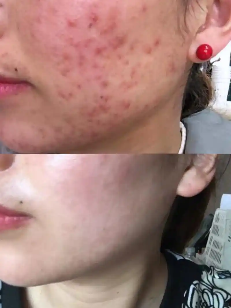 全网搜寻脸长痘的美女#脸上的痘痘终于好了 #拯救痘痘肌 #爆 - 抖音
