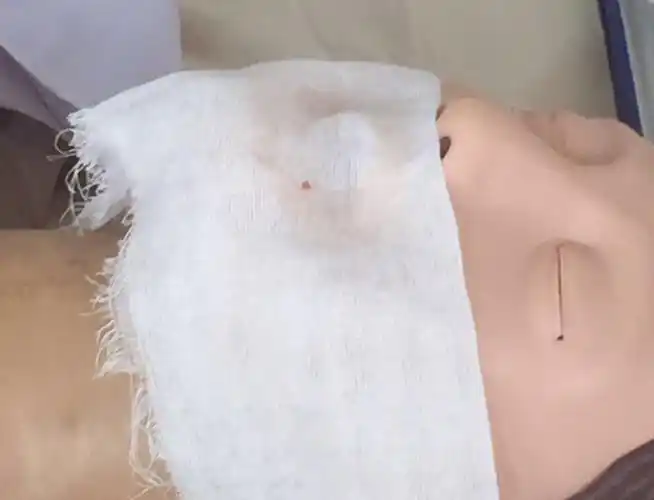 看看纱布上的血迹就知道大家的付出,操作中带血的纱布不止这一块,这