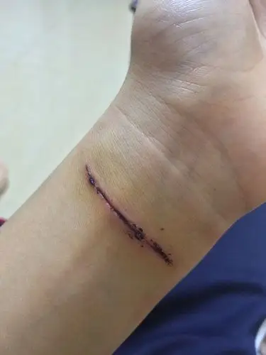 不小心划到,伤口已经消毒过了,会不会留疤(2天了)
